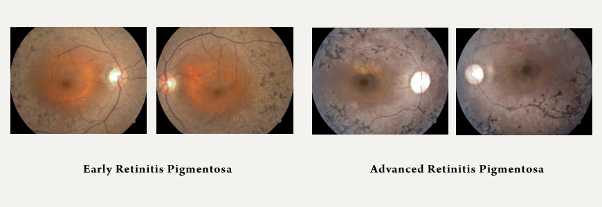 Early and Advanced Retinitis Pigmentosa